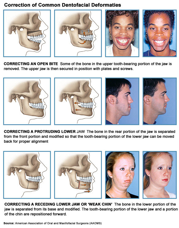 Dentofacial Orthodontic Surgery, Vancouver, BC