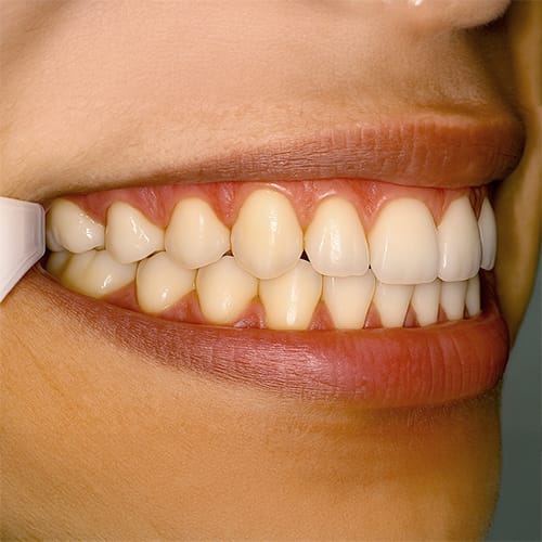 Virtual Consultation Smile Image Example - Right Bite