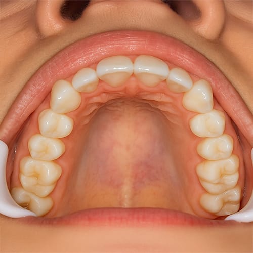 Virtual Consultation Smile Image Example - Upper Arch
