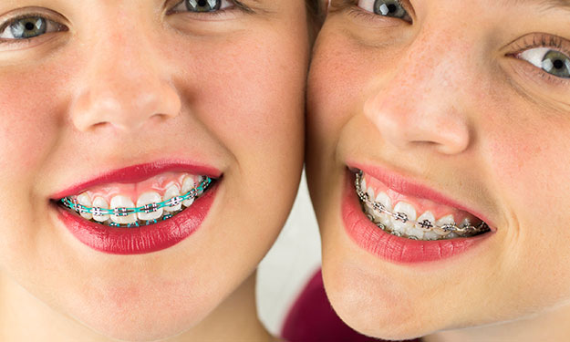 Coloured Braces Consultation Vancouver Orthodontics 