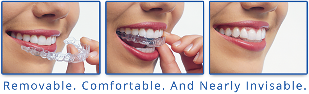 Straighten Your Teeth With Invisalign