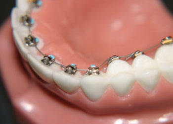 Surrey Lingual Braces Treatments for Rotated Teeth